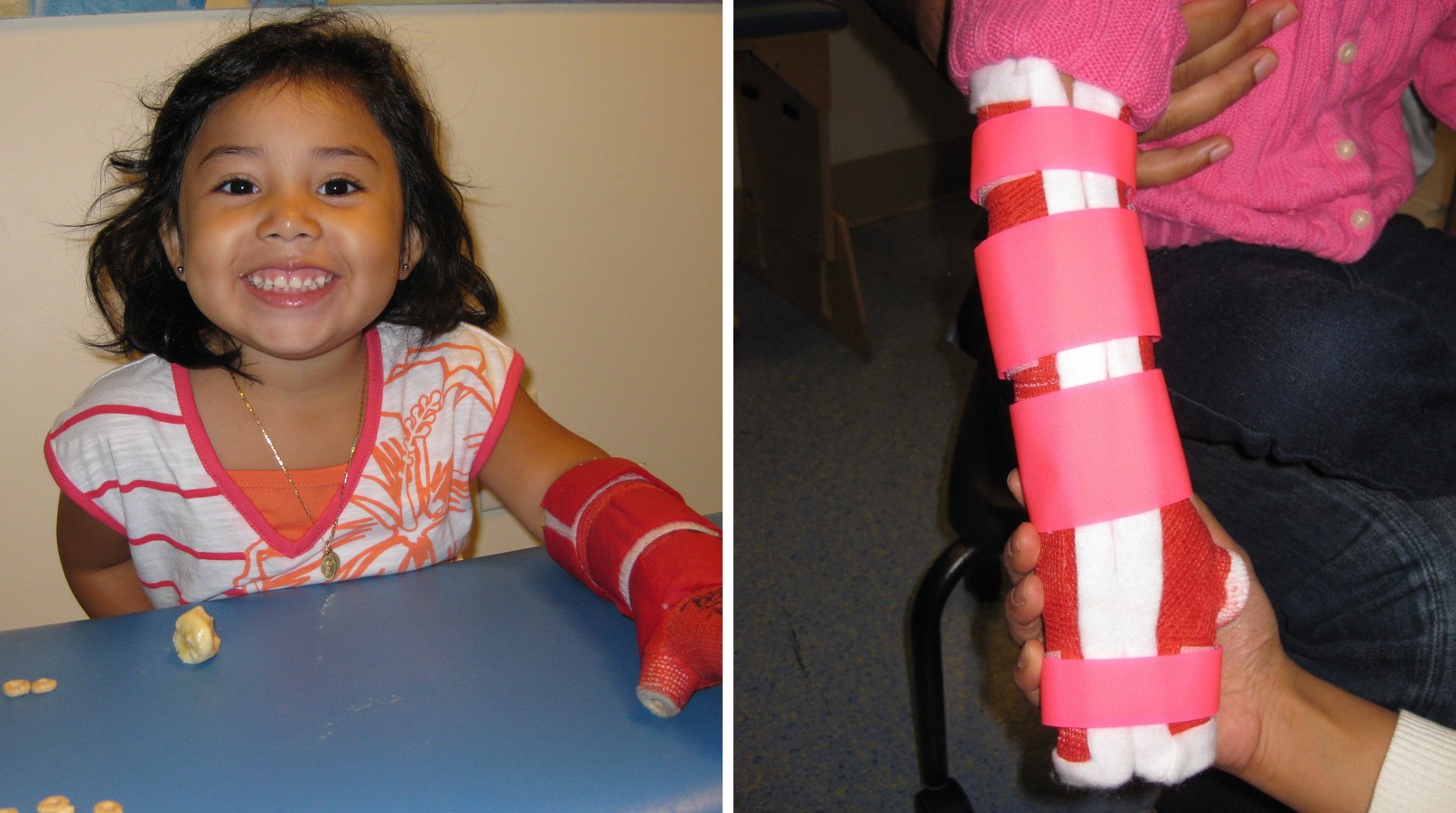 A collage of two photos showing custom Constraint-Induced Movement Therapy hand splints being fabricated and fitted for a child.