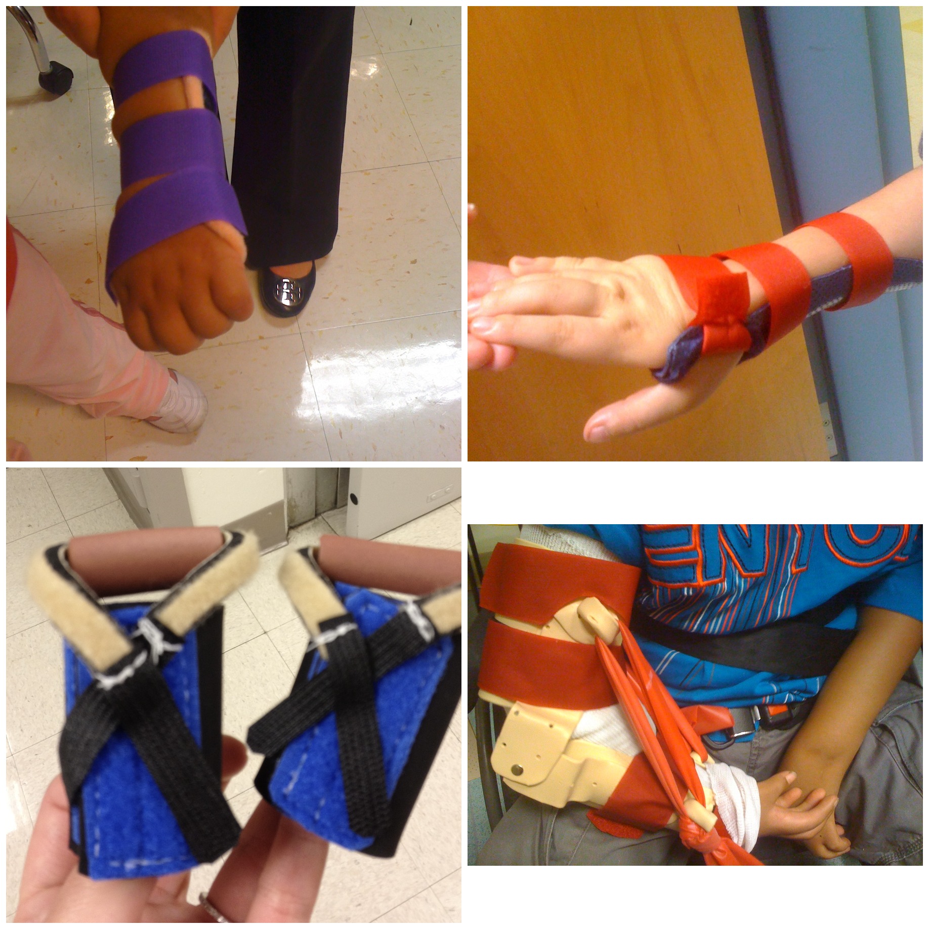 A collage of four photos showing custom pediatric hand and wrist splints in purple, orange, and blue, used to support children's hand positioning and development.
